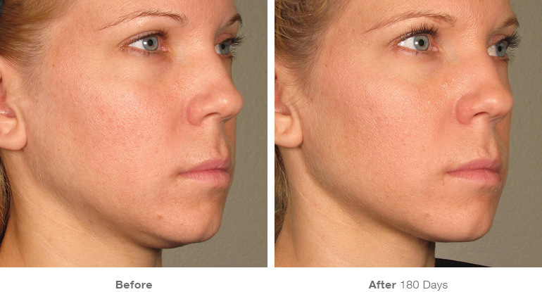 before_after_ultherapy_results_full-face23
