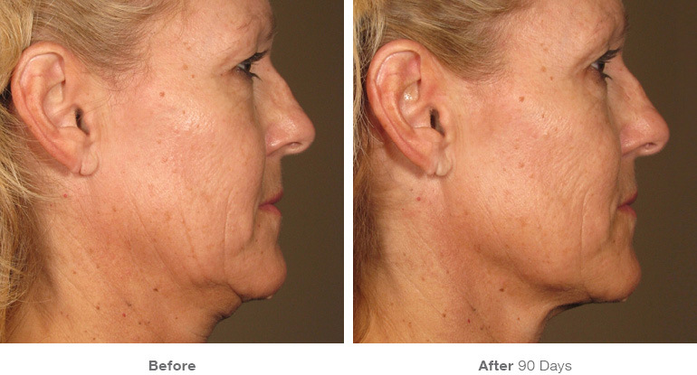 before_after_ultherapy_results_full-face24