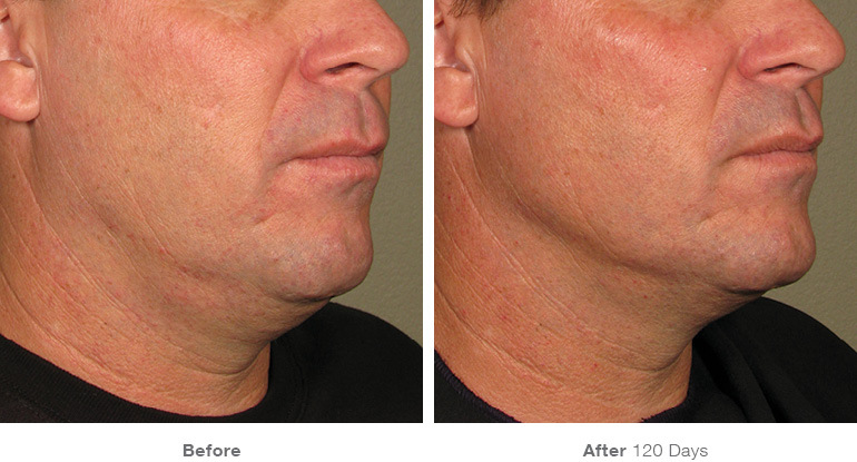 before_after_ultherapy_results_under-chin12