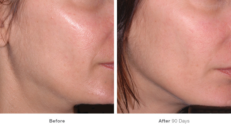 before_after_ultherapy_results_under-chin32