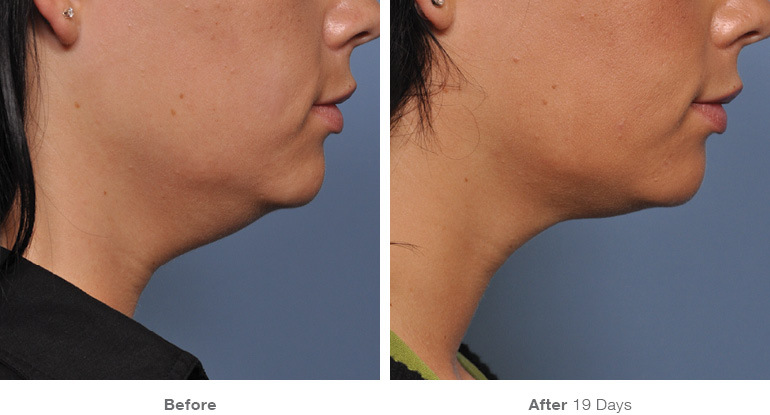 before_after_ultherapy_results_under-chin38