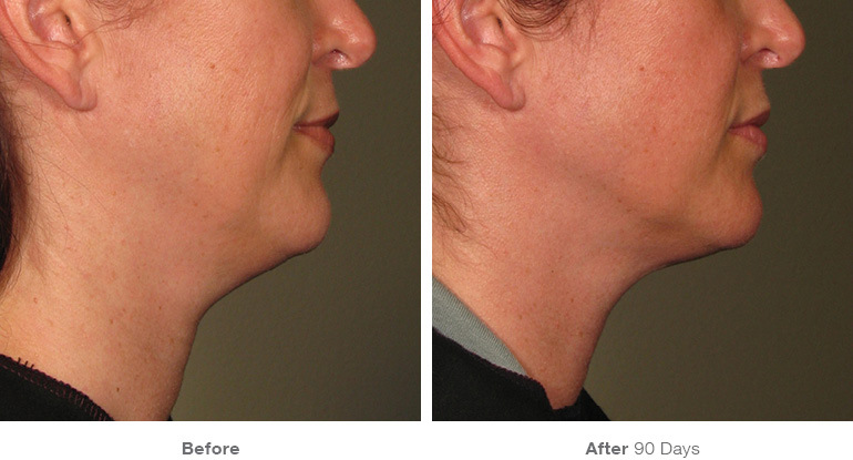 before_after_ultherapy_results_under-chin7
