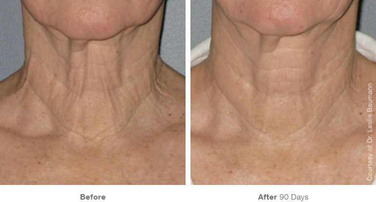 ultherapy-bl0017_90day_1tx_neck_gallery
